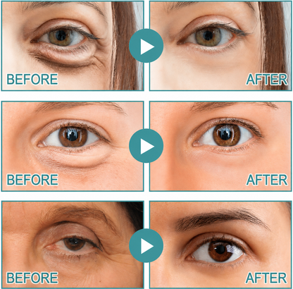Tryvonna | Dissolving Microneedle Eye Patches